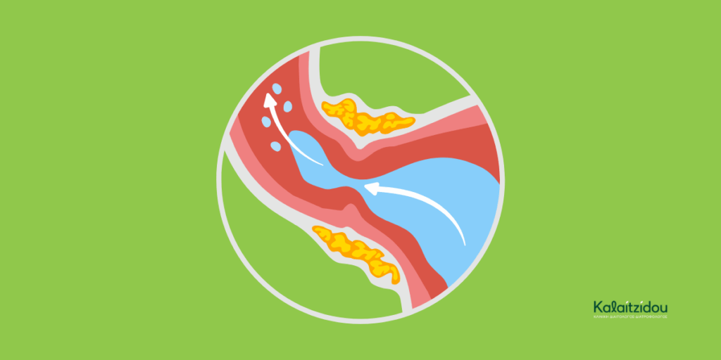 Γαστροοισοφαγική Παλινδρόμηση