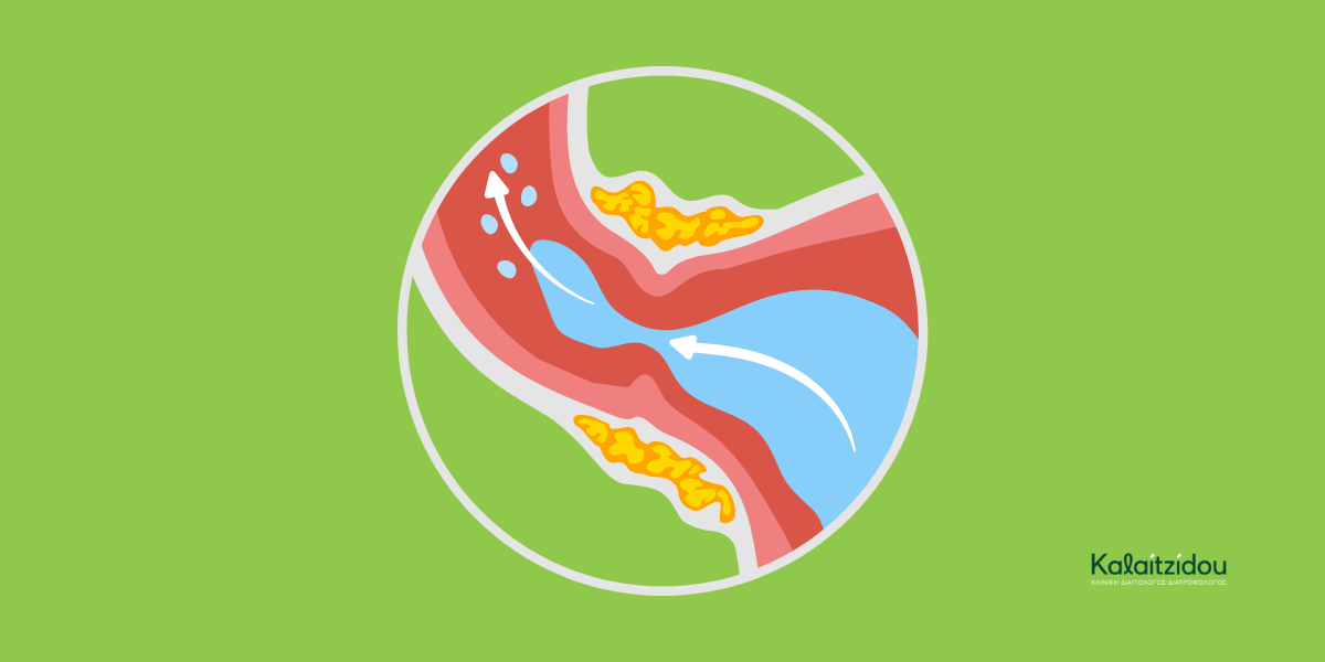 Γαστροοισοφαγική Παλινδρόμηση